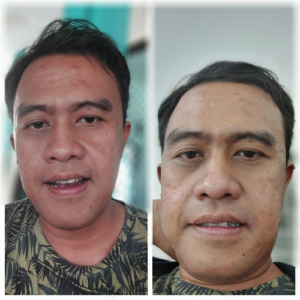 suntik botox di ZAP