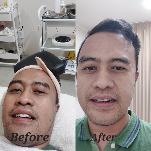 hasil facial dermaglow